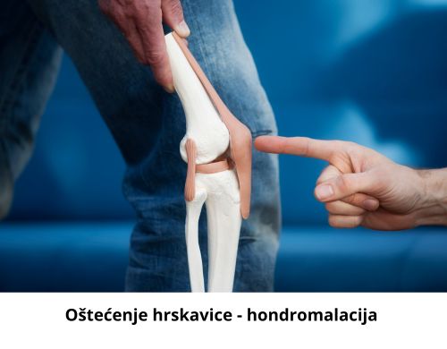 Oštećenje hrskavice - hondromalacija